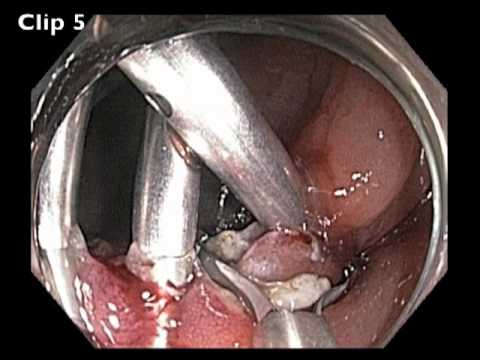 Flat Lesion in Cecum - Closure