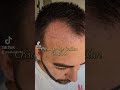 #injertocapilar #hairevolution #trasplantecapilar