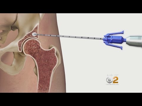 Helping Patients Avoid Surgery And Repair Damaged Hips