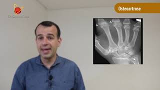 Osteoartrose
