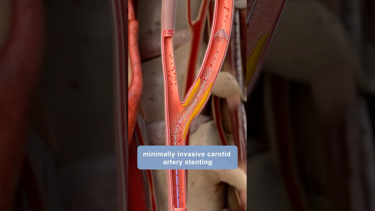 Atherosclerosis & stenting procedures in 3D!