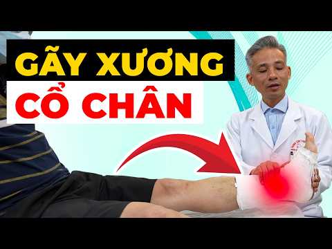 Gãy Xương Cổ Chân: Sai Lầm Khiến Chân Lâu Liền, Dễ Đi Tập Tễnh Về Sau