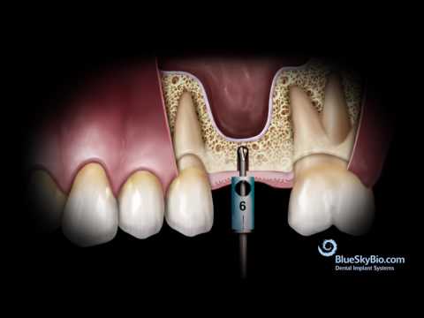 Advanced Simplified Sinus Lift Technique (No Probe)