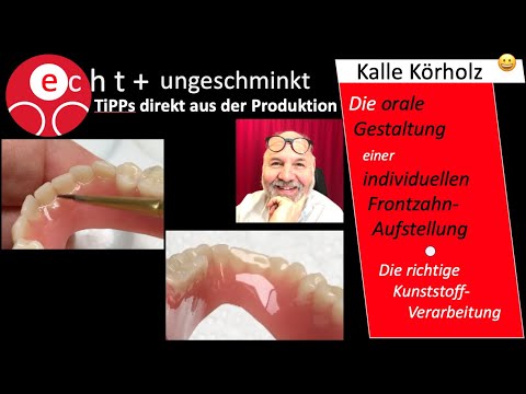 Saubere oral gestaltete Bereiche - auch bei individueller Frontzahn-Aufstellung
