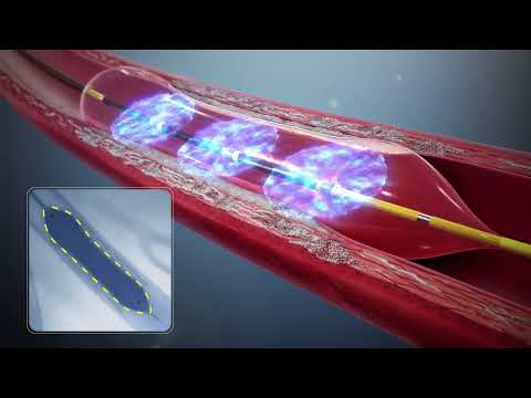 Shockwave Intravascular Lithotripsy (IVL) System at Cheyenne Regional