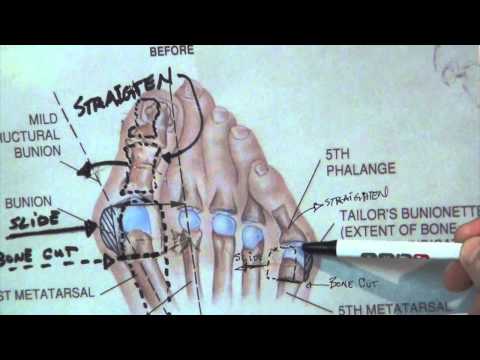 How do you fix a Bunionette - Tailor's Bunion?