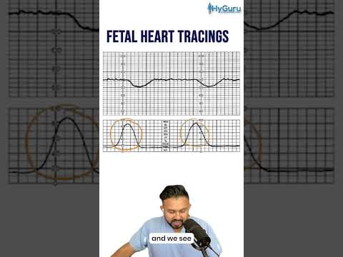 Fetal Heart Tracings for the USMLE | HyGuru