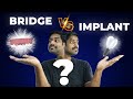 பல் கட்டுவதில் எது சிறந்த முறை Dental Bridge V S