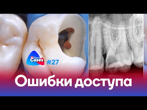 Ошибки эндодонтического доступа | Дентал Кейсы от BG #27