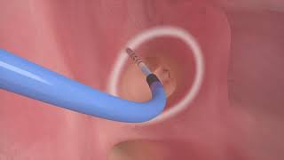 Re: [閒聊] 心導管手術