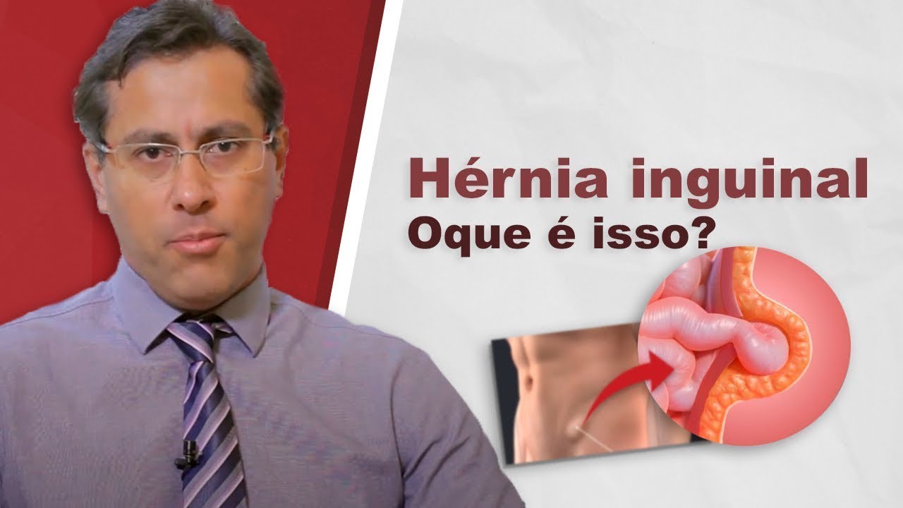 Watch Now Hérnia inguinal: o tipo de hérnia abdominal mais comum Hérnia inguinal: o tipo de hérnia abdominal mais comum
