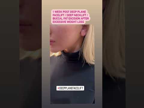 Watch Video: Dr. Rizk shares his patient’s results one week after Rhinoplasty