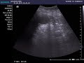 Spleen Additional Lobe Hyperplasia