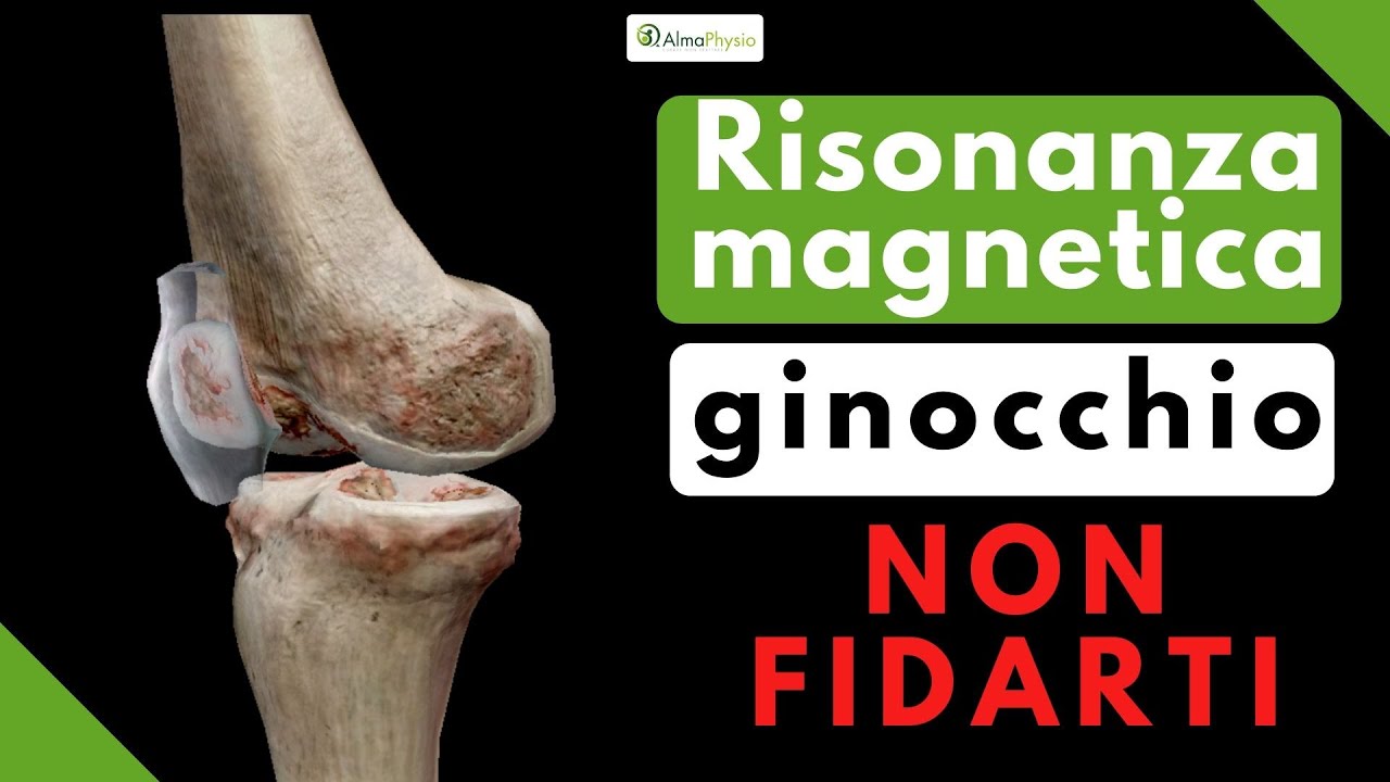 Watch Now Risonanza magnetica al ginocchio: NON FIDARTI!!! Risonanza magnetica al ginocchio: NON FIDARTI!!!
