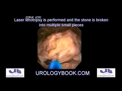 Ureteroscopy Pyeloscopy Laser Lithotripsy