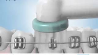 Для брекетов и имплантов: Oral-B Ortho и Power Tip