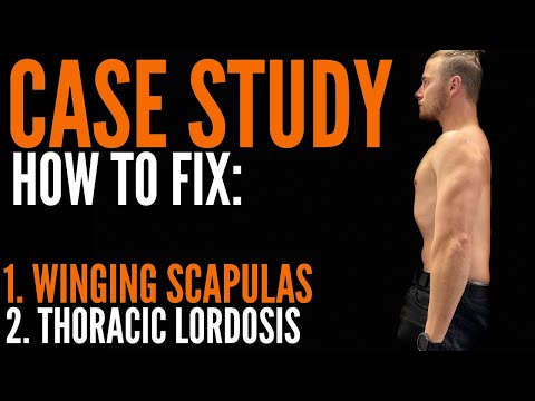 HOW TO FIX: Winging Scapulas and Thoracic Lordosis