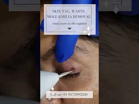 Skintag, Milia, Wart and Mole Removal | Beyond Aesthetics