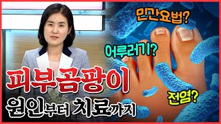 습한 날씨 때문에 더 심해지는 피부 곰팡이, 어루러기와 무좀 예방하자! [건강이 최고다]