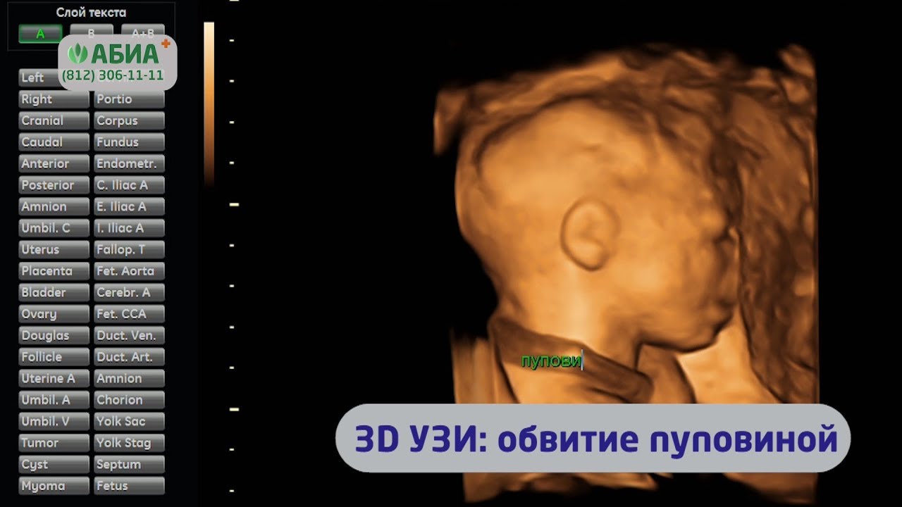 3D ÓÇÈ: îáâèòèå ïóïîâèíîé