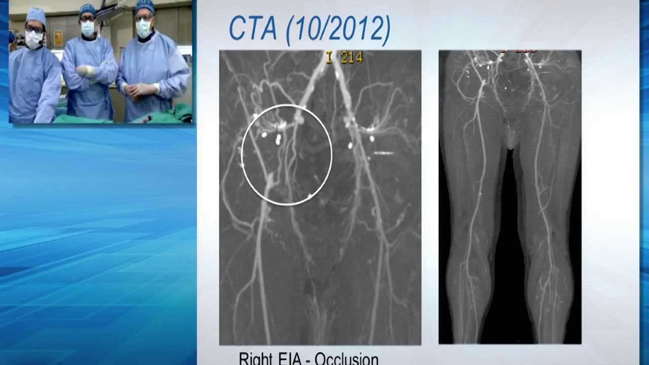 Bilateral Buttock and Lower Extremity Claudication - YouTube