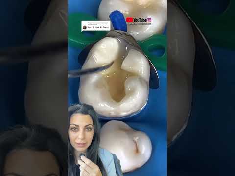 Dental filling procedure | dental filling video | Dr. Yazdan | dental filling between teeth