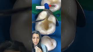 Download lagu Dental filling procedure | dental filling video | Dr. Yazdan | dental filling between teeth mp3 Download lagu Dental filling procedure | dental filling video | Dr. Yazdan | dental filling between teeth mp3