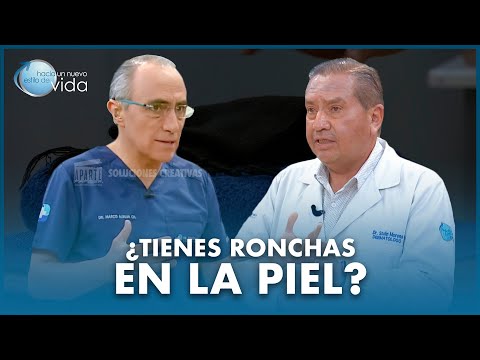 ¿TIENES RONCHAS EN LA PIEL? 🧐