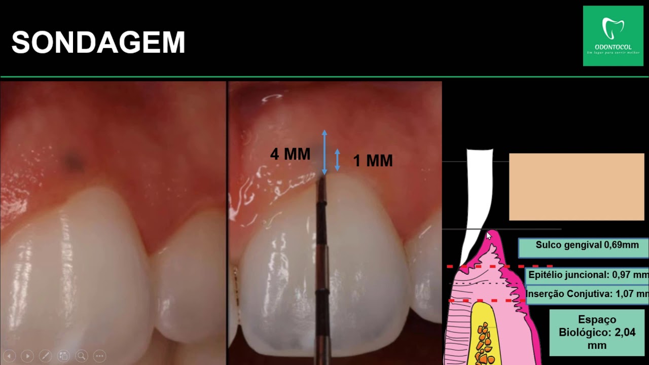 Periodontia: Aumento de Coroa Clínica: Diagnóstico e Sondagem - Aula 03