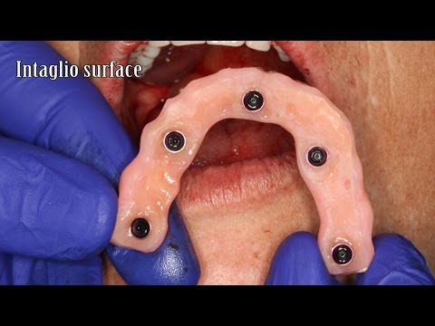 Introducing LOCATOR F-Tx Fixed Attachment System