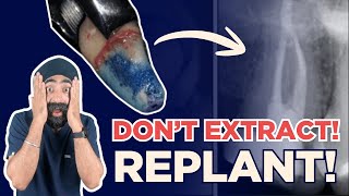 Before You Extract: Intentional Replantation in Practice - PDP256