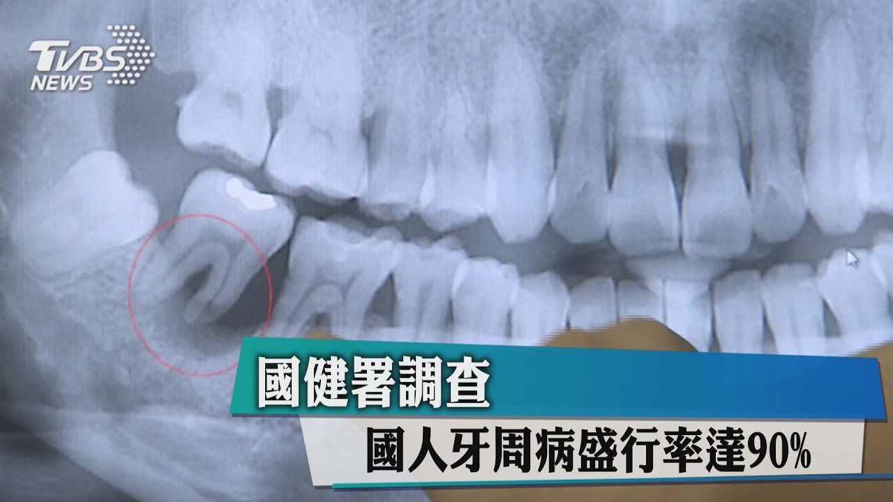 國健署調查　國人牙周病盛行率達90%