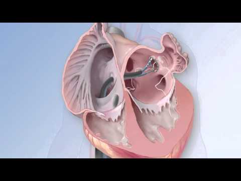 Freezing heart muscle to stop racing