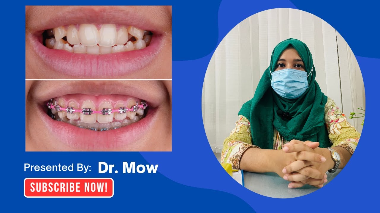 আঁকাবাঁকা দাঁত সোজা করার ব্রেসেস চিকিৎসা নিয়ে আমি খুশি। - Video Review