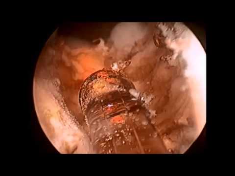 Bubnovsky von Prostata-Adenom Prostata-Adenom Behandlungstechnik