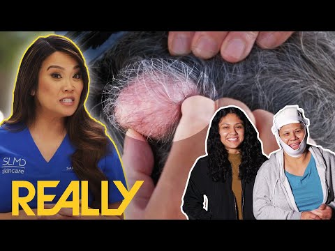 Dr Lee Helps Woman With 'Second Head' Pilar Cysts Gain Back Control Of Her Life | Dr Pimple Popper