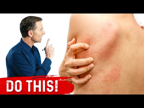 What is Histamine Intolerance? High Histamine Foods to Avoid – Dr.Berg