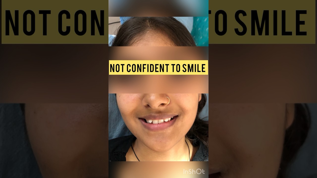 Minor alignment correction using metal braces in 6 months #orthodontist