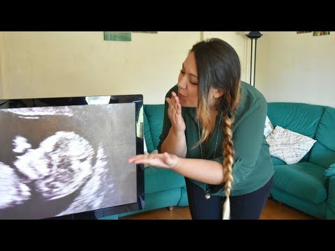 Il dolore nel cuore e nelle articolazioni delle mani Ð ± оР»N NOE D² пинÐμ Ð ± ол DN, гоР»Ð¾Ð²Ð ° Ñ ‡ Ñ, о ÐÐμл Ð ° n, NOE