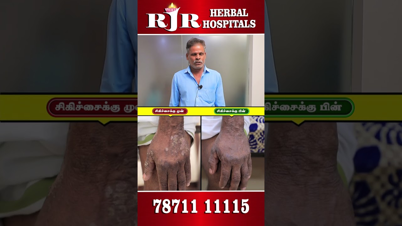 சொரியாசிஸ் தோல் நோய் சிகிச்சை (PSORIASIS)