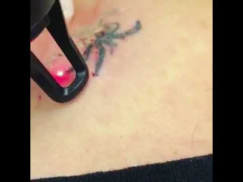 Laser Tattoo Removal with the Alma Q logo