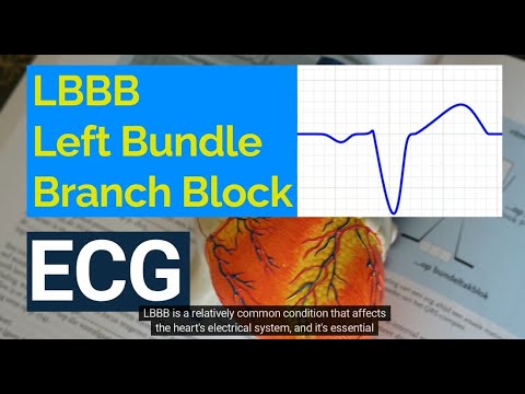 Understanding Left Bundle Branch Block (LBBB) on ECG: Causes, Symptoms, and Treatment.