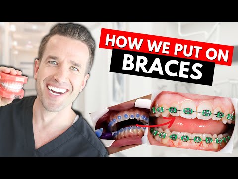 How Braces are Put On | Part IV| Dr. Nate