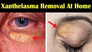 How to Get Rid of Xanthelasma Around Eyes || Top 3 Home Remedies for Xanthelasma Removal