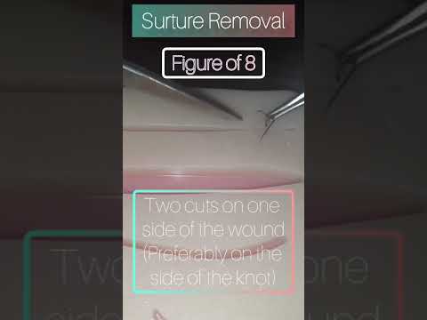 #suture removal। Figure of 8