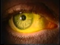 Instilling Fluorescein Dye in the Eye