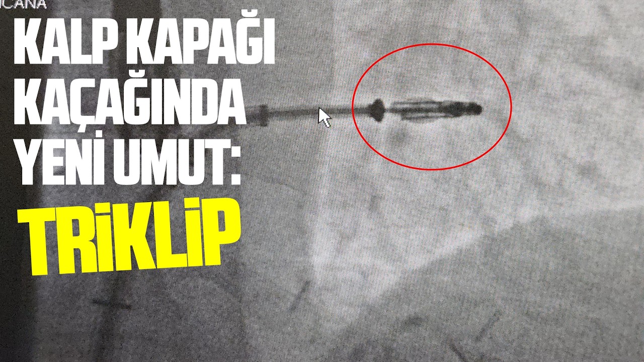 Kalp kapağı kaçağında yeni umut: "Triklip"