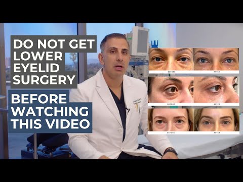The truth about lower lid blepharoplasty : what your surgeon should be telling you