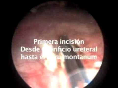 Forte dolore nella prostatite PSA cancro alla prostata