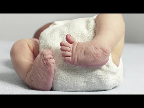 Risk Factors of Clubfoot